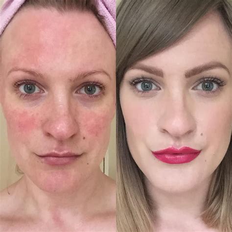 dating someone with rosacea